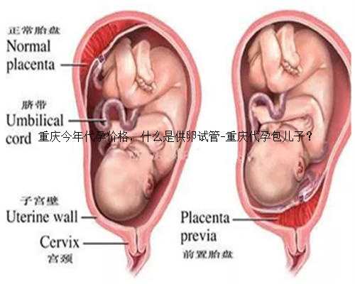 重庆今年代孕价格，什么是供卵试管-重庆代孕包儿子？